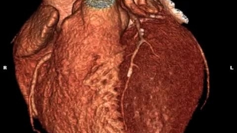 Thumbnail for SCOT-HEART Research Project