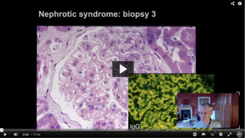 Thumbnail for entry Proteinuric diseases and nephrotic syndrome