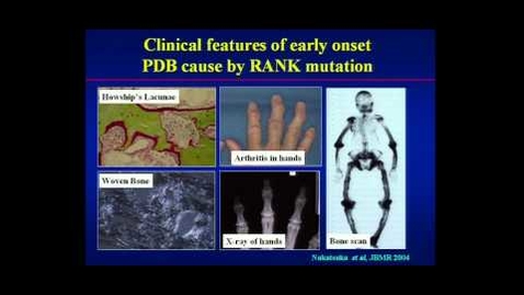 Thumbnail for Prof. Stuart Ralston - Solving the Mysteries of Paget's Disease