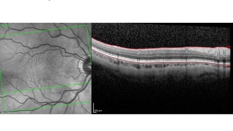 Thumbnail for OCT Paper Supplemental Videos - CKD - diseased subject