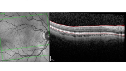 Thumbnail for entry OCT Paper Supplemental Videos - CKD - diseased subject