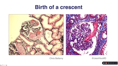 Thumbnail for Haematuric diseases and crescentic nephritis