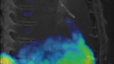 Thumbnail for 8F-fluciclatide uptake in the myocardium of a patient with a recent anterior ST-segment elevation myocardial infarction showing region of re-endothelialisation and angiogenesis
