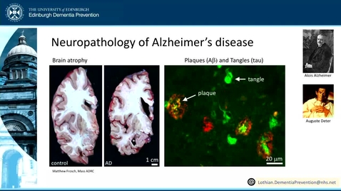 Thumbnail for entry 2. What is Neurodegenerative Disease? (part 2)