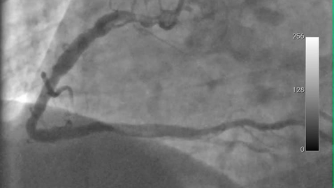 Thumbnail for entry PRE18FFIR Project: Invasive Coronary Angiography