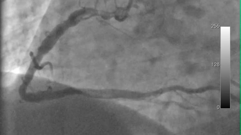 Thumbnail for PRE18FFIR Project: Invasive Coronary Angiography