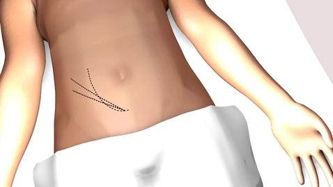 Thumbnail for Kidney Transplantation