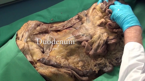 Thumbnail for Unhide duodenum - extended Cattel Braasch manoeuvre