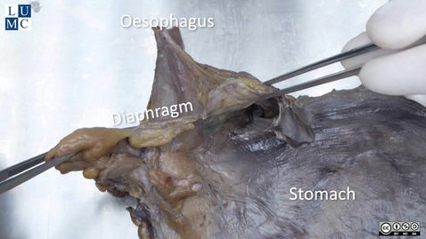 Thumbnail for Phrenicooesophageal ligament