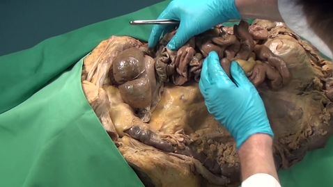 Thumbnail for (Meso)colon descendens mobilized