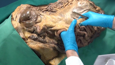 Thumbnail for Jejunum and ileum are intraperitoneal