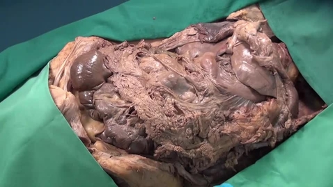 Thumbnail for MOOC 4.13 Anatomy on the table: Peritoneal structures and relations