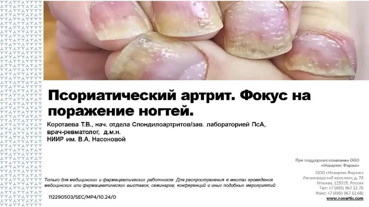 Псориатический артрит. Фокус на поражение ногтей.mp4
