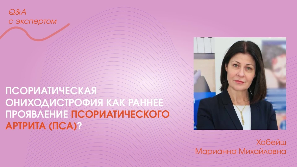 Псориатическая ониходистрофия как раннее проявление псориати