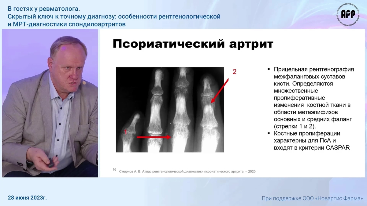 В гостях у ревматолога. «Скрытый ключ к точному диагнозу: особенности рентгенологической и МРТ-диагностики спондилоартритов».mp4