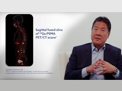 Pluvicto HCP ME Video 4