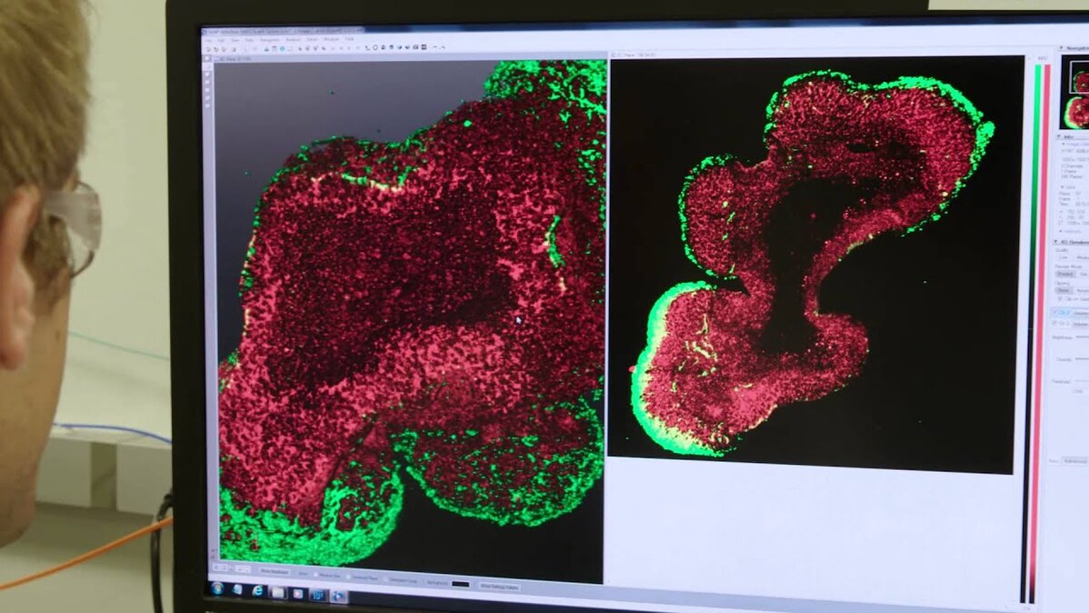 Neuroscientists model human diseases in a dish