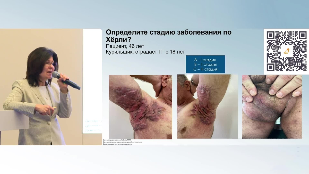 Клинический случай пациента с гнойным гидраденитом. Хобейш Марианна Михайловна