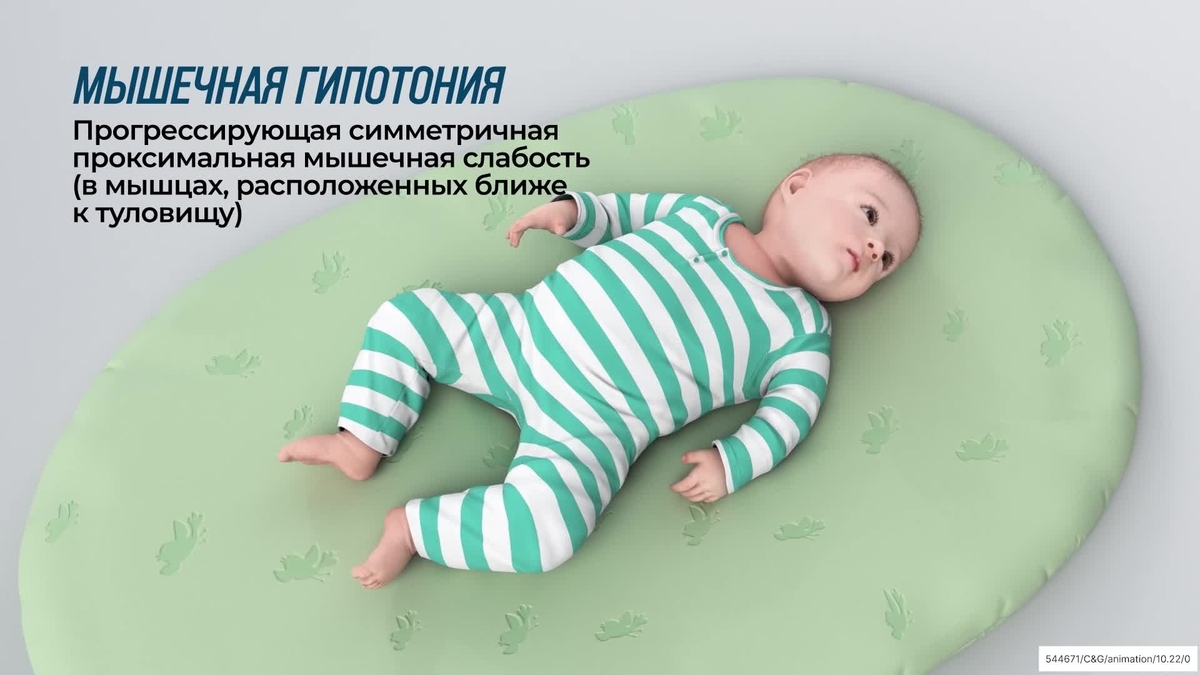 мышечная гипотония