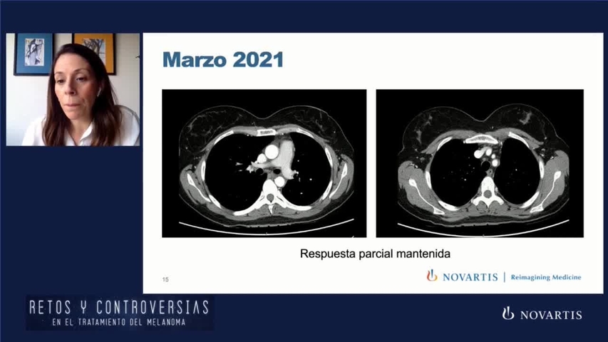 Webinar Melanoma (12 mayo) –  Evidencia Rechallenge