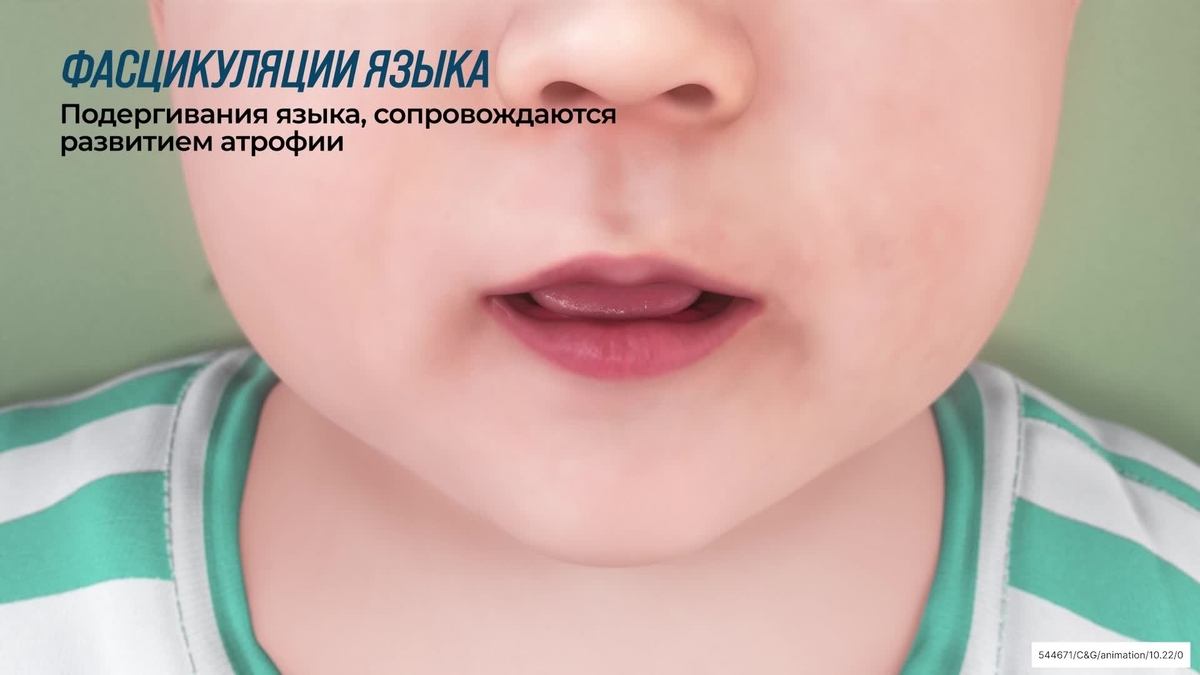 фасцикуляция языка