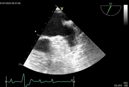 Kazuistiky z III. Cyklu - Nechme srdce bít_4_kazuistika_Video1_Transthorakální echokardiografie_videosmycka_dr. Fikrle