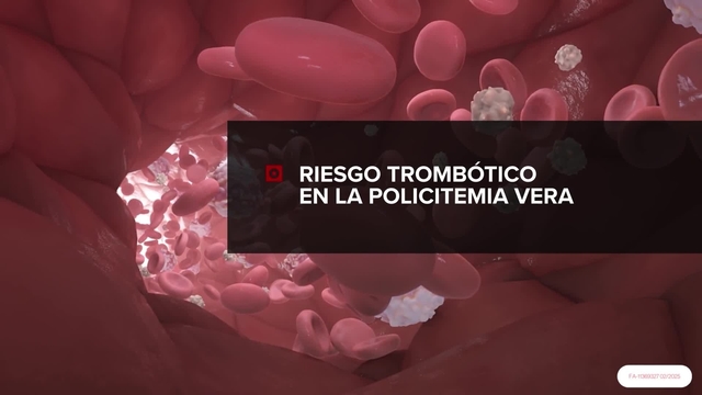Riesgo trombótico en la policitemia vera