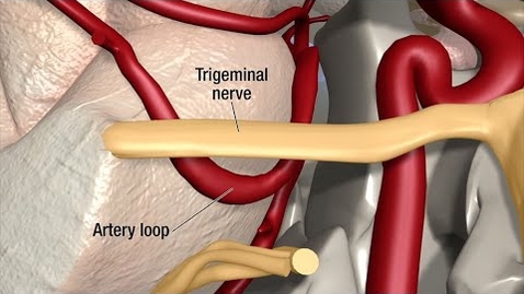 Thumbnail for Treatment for Trigeminal Neuralgia: UCSF Neurosurgery