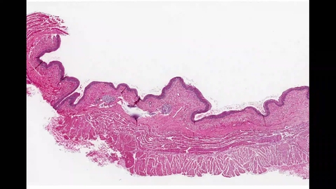 Thumbnail for Approach to the Esophagus