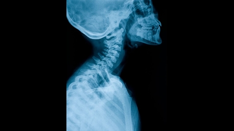 Thumbnail for Cervicogenic Headaches