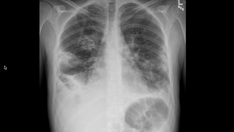 Thumbnail for Septic emboli