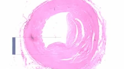 Thumbnail for PathologyModule_ Atherosclerosis_Part02