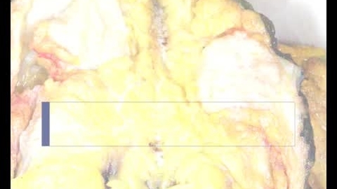 Thumbnail for entry PathologyModule_BreastCancer