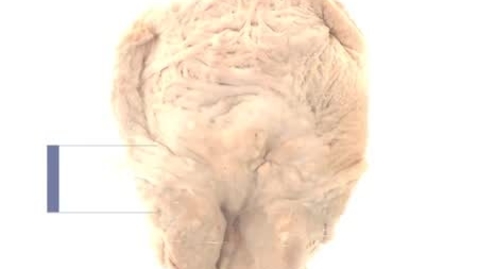 Thumbnail for PathologyModule_ProstateCancer