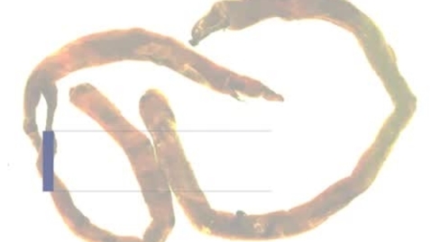 Thumbnail for PathologyModule_PulmonaryEmbolism