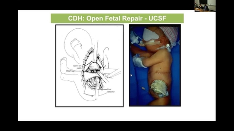 Thumbnail for entry Prenatal Intervention to Improve Postnatal Outcomes| Dr. Oluyinka O. Olutoye | June 9, 2022