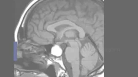 Thumbnail for entry PathologyModule_PituitaryAdenoma
