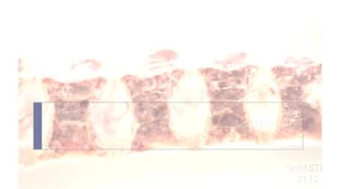 Thumbnail for PathologyModule_Osteoporosis
