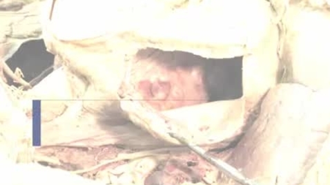 Thumbnail for PathologyModule_TricuspidAtresia