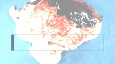 Thumbnail for entry PathologyModule_SubduralHematoma