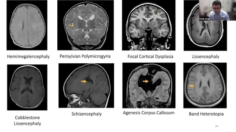 Thumbnail for entry &quot;Do seizures hurt the brain or does the hurt brain seize? Infantile Spasms: a Developmental and or Epileptic Encephalopathy | Dr. Kevin Jones, Dr. Stephanie Lavoie, &amp; Dr. Nevena Simic | April 14, 2022
