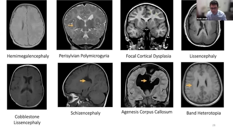 Thumbnail for &quot;Do seizures hurt the brain or does the hurt brain seize? Infantile Spasms: a Developmental and or Epileptic Encephalopathy | Dr. Kevin Jones, Dr. Stephanie Lavoie, &amp; Dr. Nevena Simic | April 14, 2022