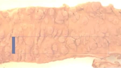 Thumbnail for PathologyModule_CrohnDisease