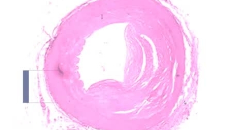 Thumbnail for PathologyModule_Atherosclerosis_Part01
