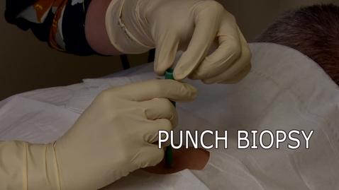 Thumbnail for entry Punch Biopsy