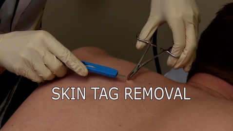 Thumbnail for entry Skin Tag Removal