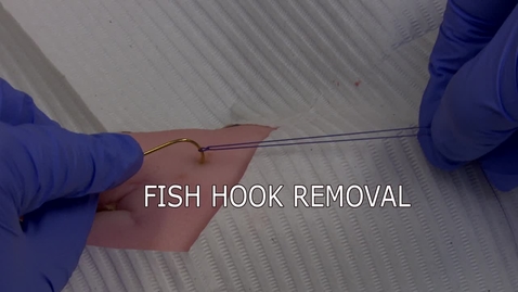 Thumbnail for entry Fish Hook Removal