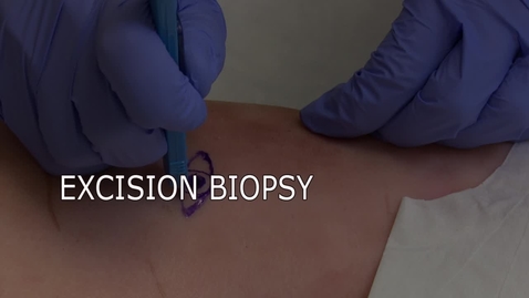 Thumbnail for Excision Biopsy