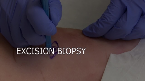 Thumbnail for entry Excision Biopsy