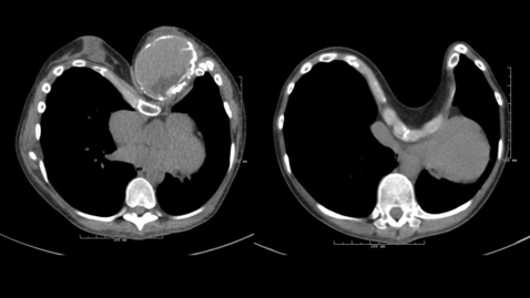 Thumbnail for Modified Ravitch Procedure for Pectus Excavatum